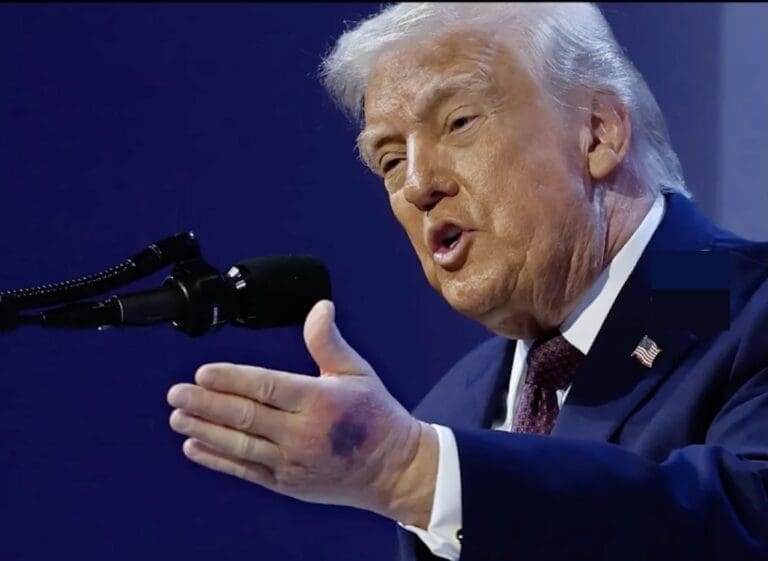 Lire la suite à propos de l’article Trump : examen médical, hématomes et doutes sur sa santé relancent le débat autour du président américain